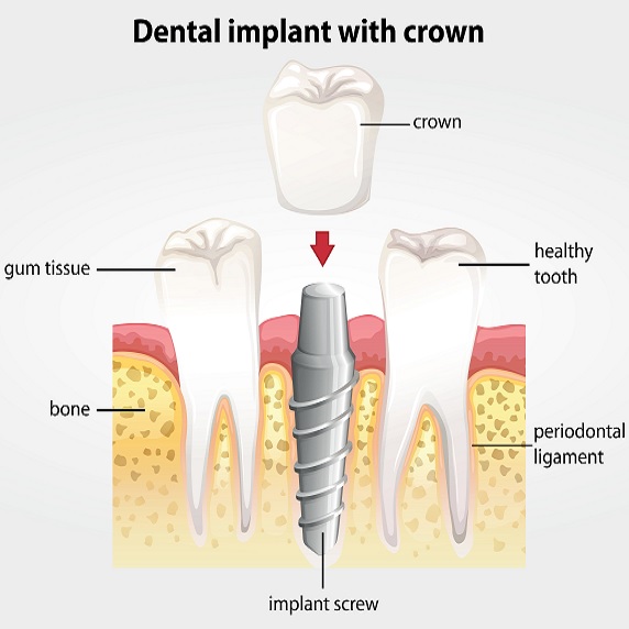 dental implants